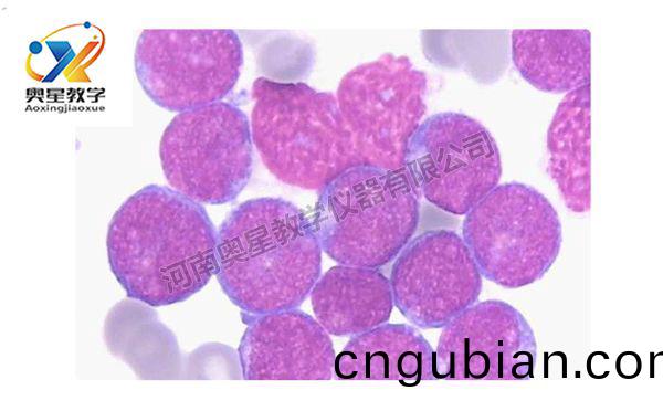 急(ji)性痳巴細(xi)胞白(bai)血(xue)病