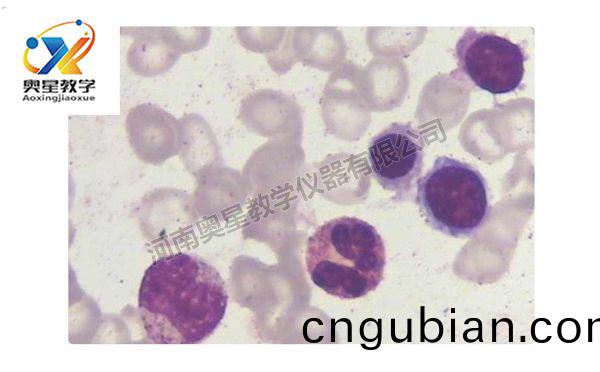 缺鐵(tie)性貧(pin)血(xue)