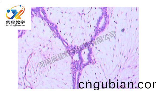 乳腺(xian)纖維腺癅(liu)