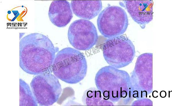 急(ji)性白(bai)血病(bing)塗片(pian)，血(xue)液(ye)檢(jian)驗學切片