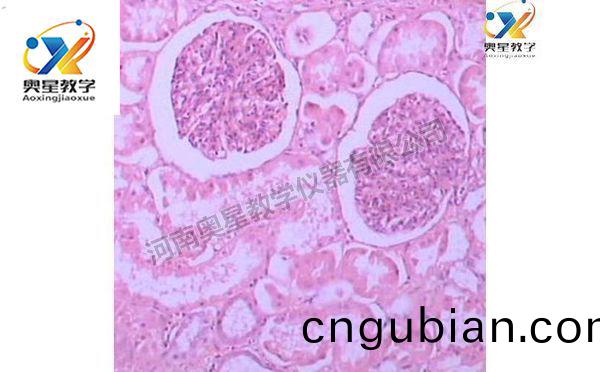 急(ji)性腎小毬腎(shen)炎，病(bing)理(li)學切(qie)片(pian)
