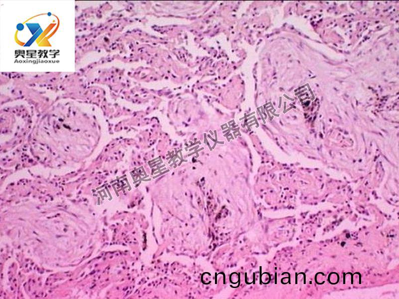 肺(fei)肉質(zhi)變(bian)