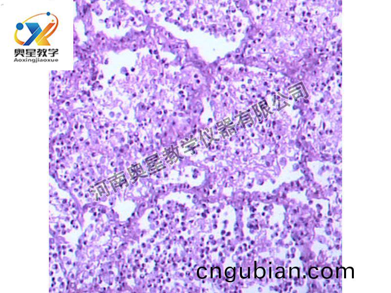 大葉性肺(fei)炎(灰(hui)肝期(qi))