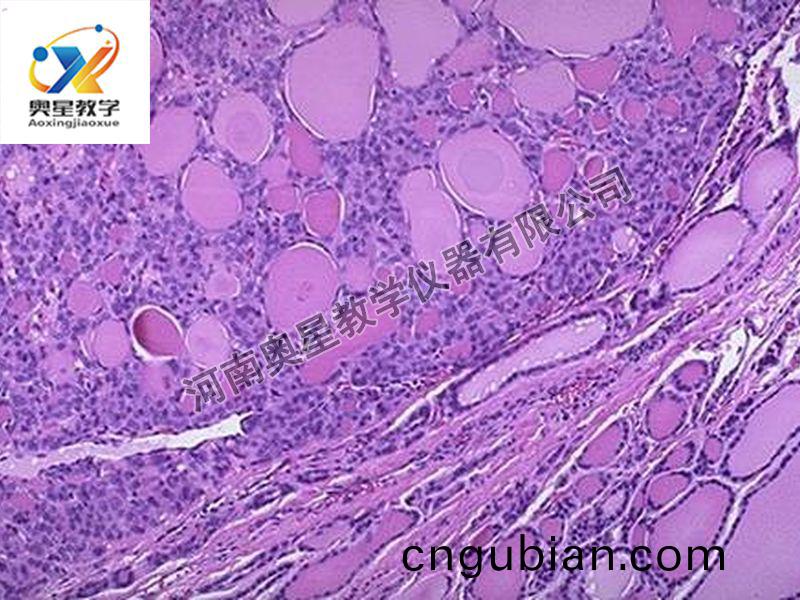 甲(jia)狀腺(xian)腺癅