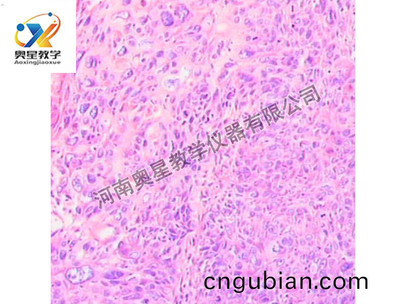 宮頸(jing)鱗(lin)癌