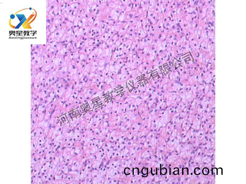 腎(shen)透(tou)明(ming)細(xi)胞癌(ai)
