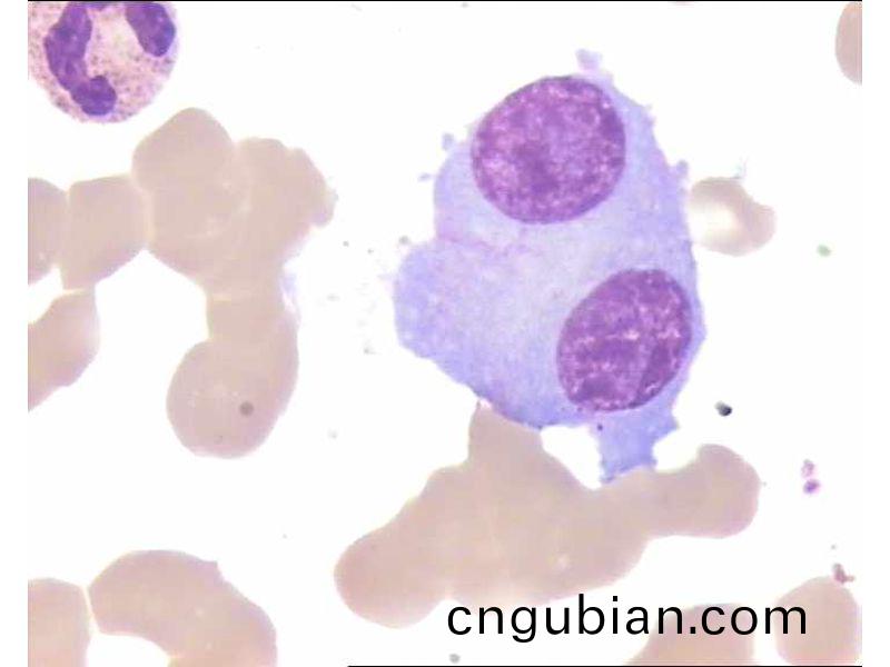 多(duo)髮(fa)性(xing)骨(gu)髓癅(liu)