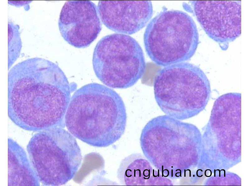 急(ji)性白(bai)血(xue)病(bing)M5