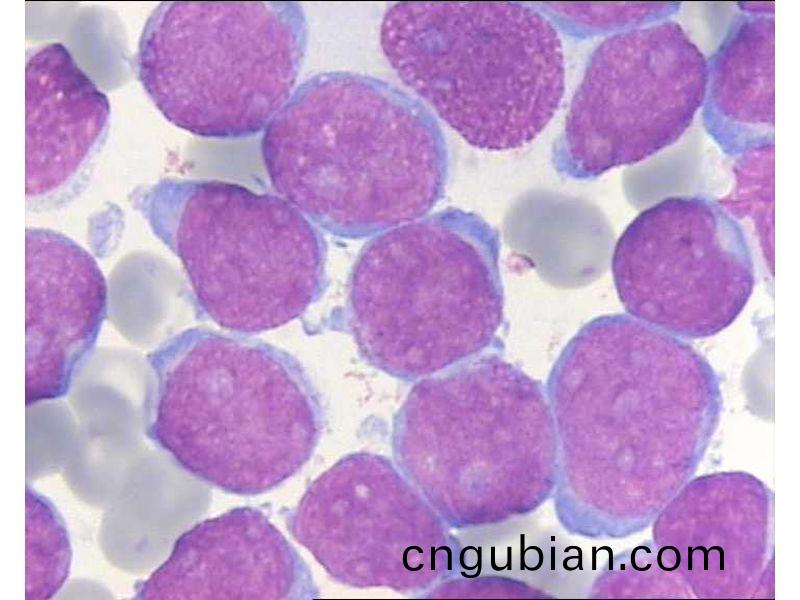 急性白血(xue)病M2