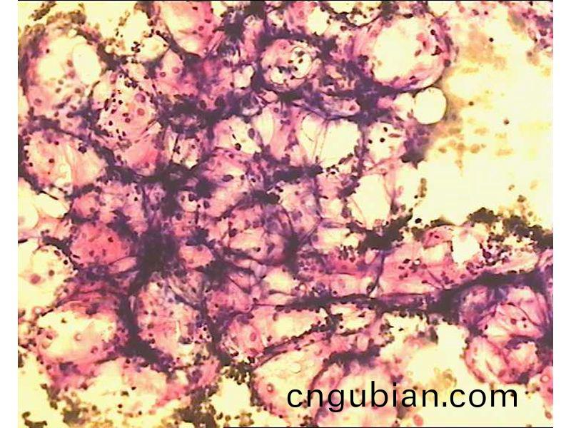 再生(sheng)障(zhang)礙性(xing)貧(pin)血